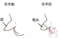 包皮的故事：什么样的包皮需要割？什么时候适合割？